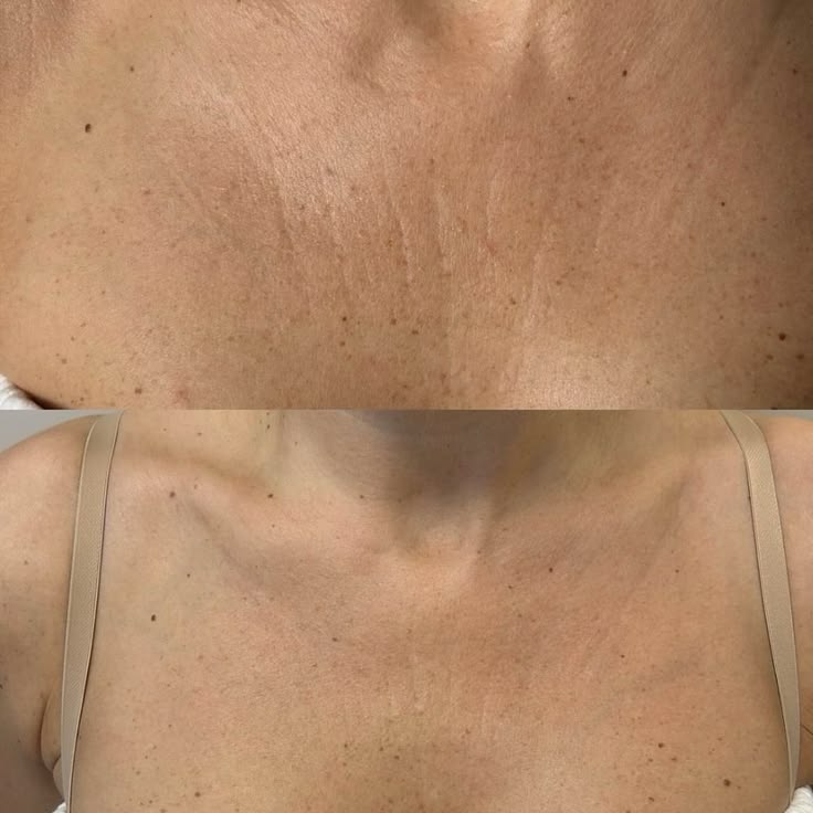 The same patch of skin between the breasts, ten weeks apart — left, crepey and lined; right, visibly smoother and firmer after the protocol