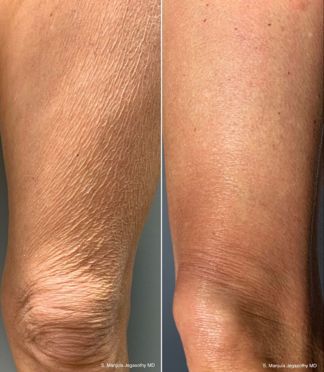 Same patch of skin above the knee, ten weeks apart — left, crepey and loose; right, visibly firmer and smoother after the protocol